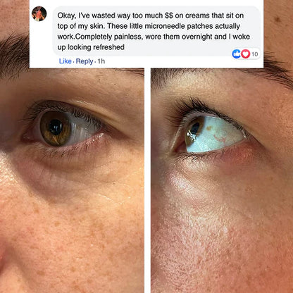 Microneedle Patches